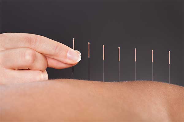 Acupuncture et sommeil 